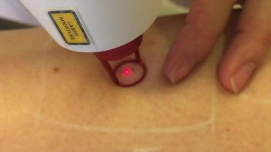 Laser para Varicoses